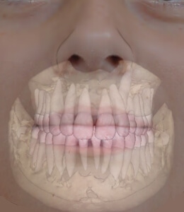 Technology Teeth in Mouth Preview