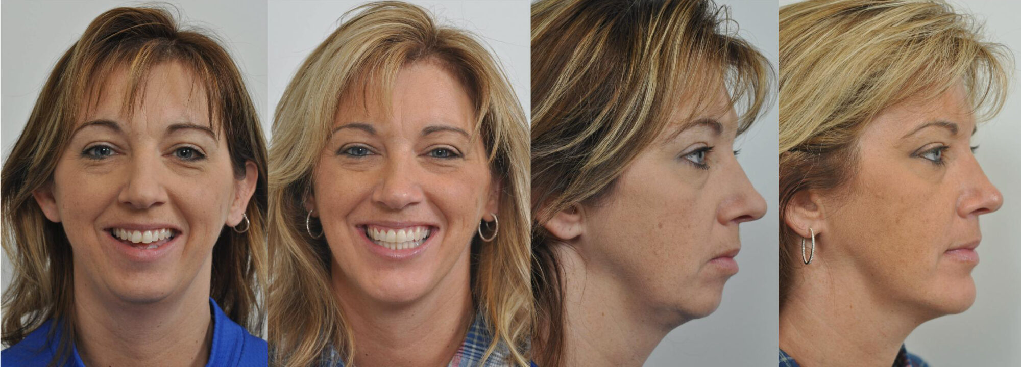 Orthognathic Surgery