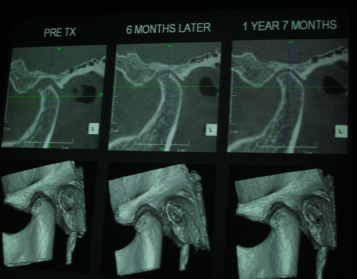 TMD Treatment