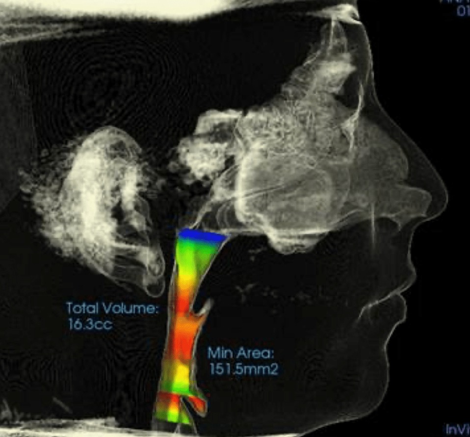 Airway & Bite Alignment