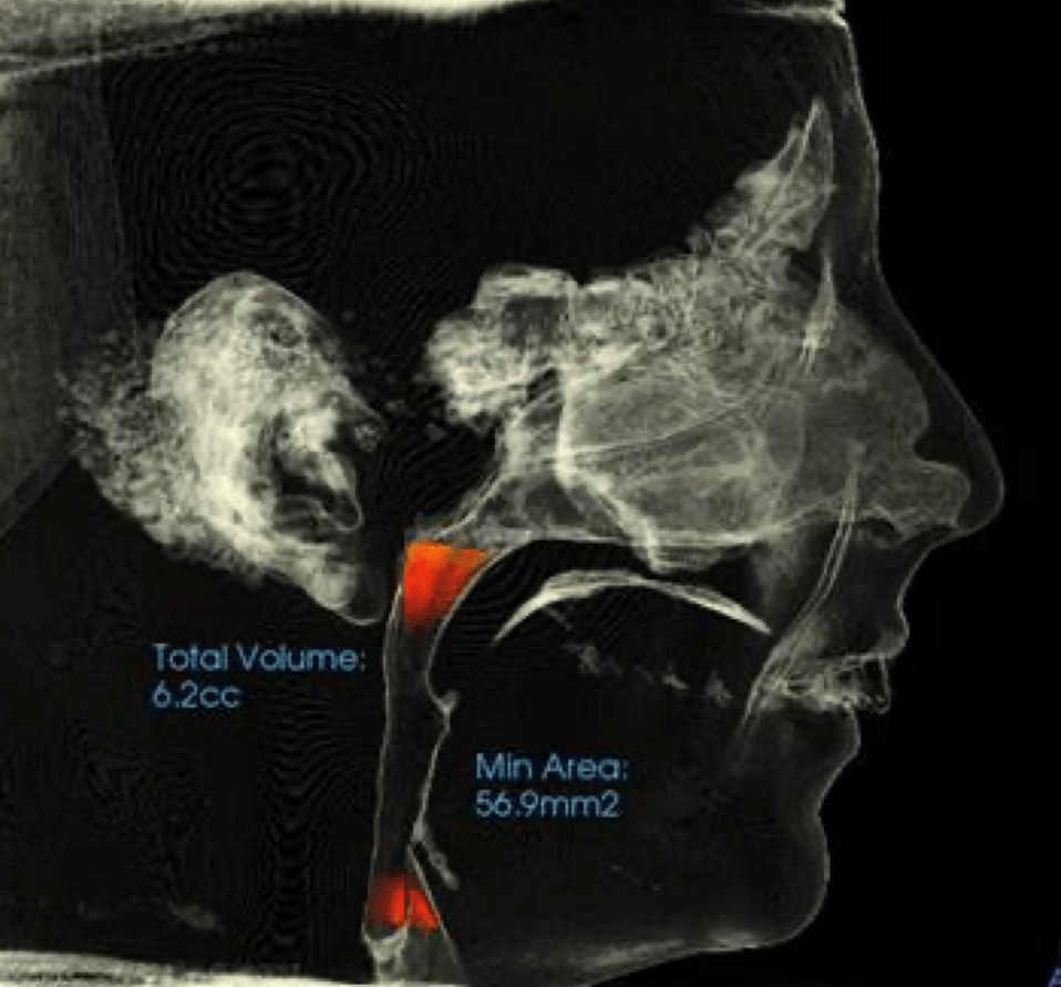 Airway & Bite Alignment