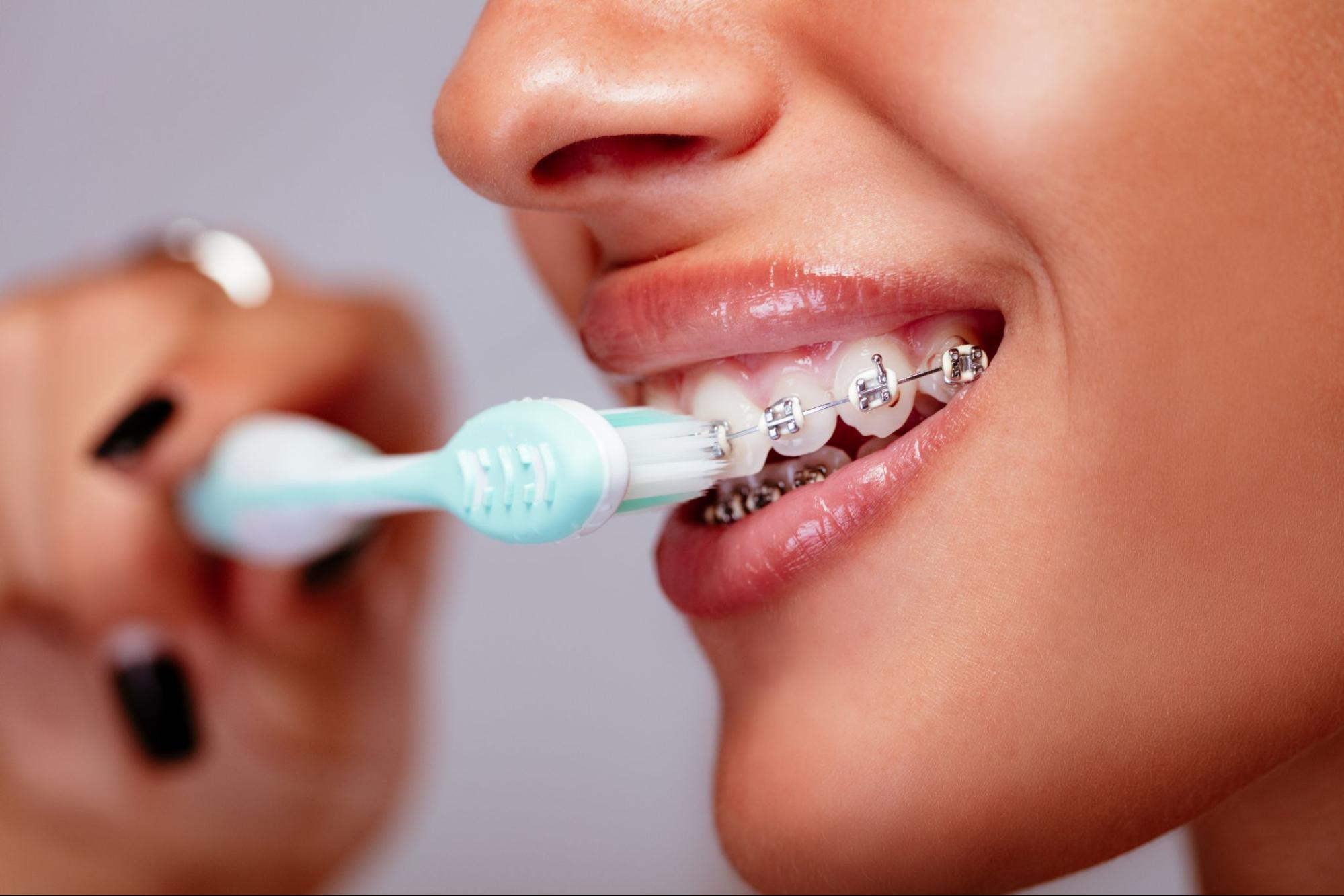 brushing tips for braces